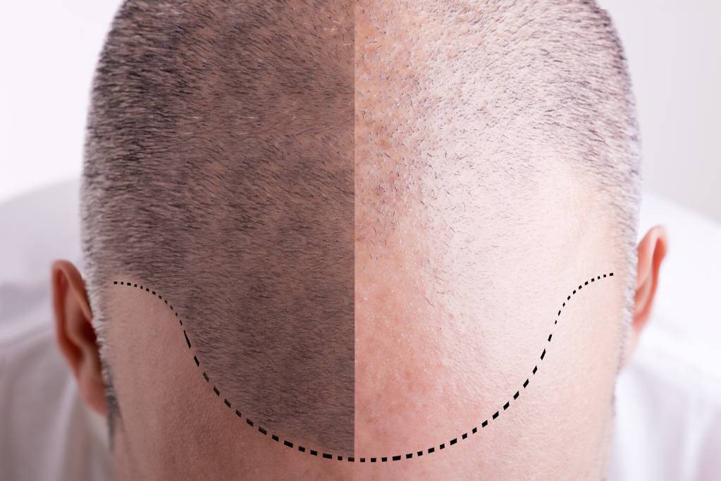Best Hair Transplant Clinic in Bangalore