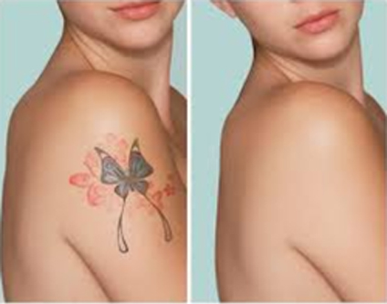 Tattoo Removal Surgery in Bangalore  Dr Shettys Cosmetic Clinic